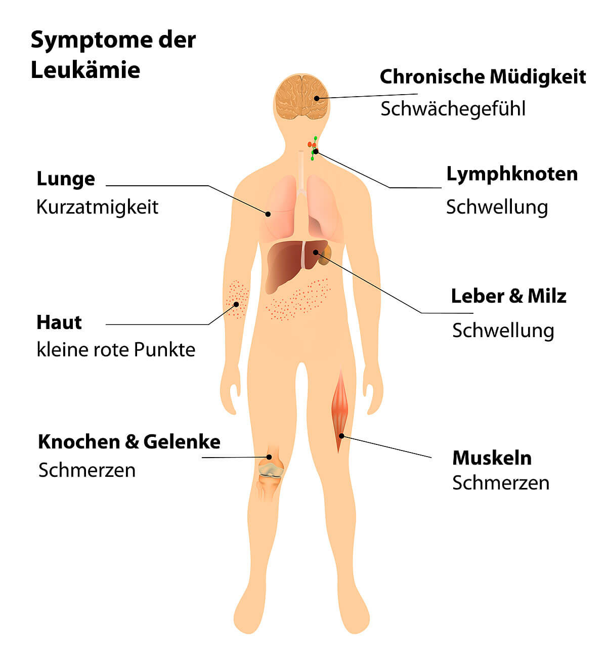 Die wichtigsten Symptome der Leukämie