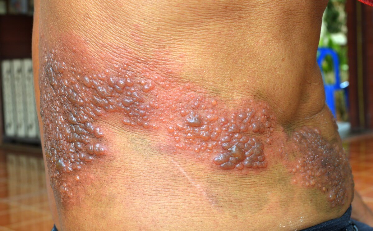 herpes on arm pictures #11