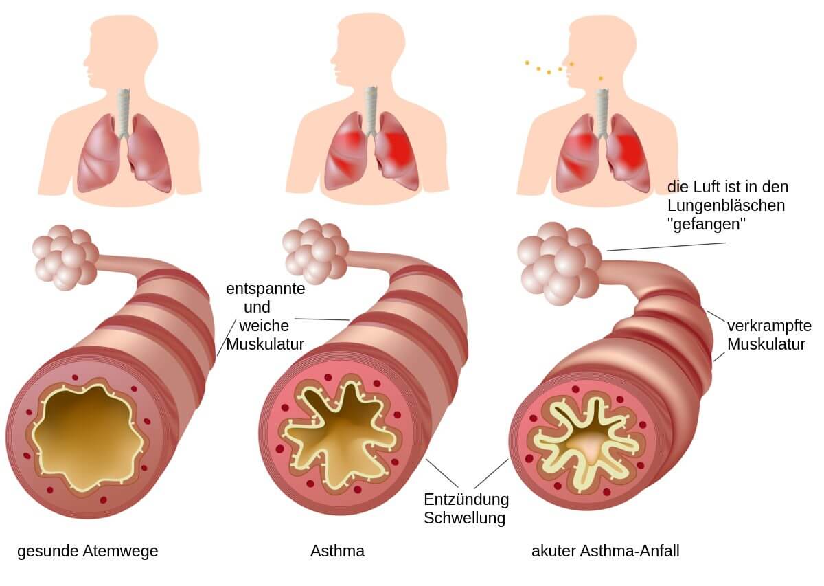 Asthma - schematische Darstellung