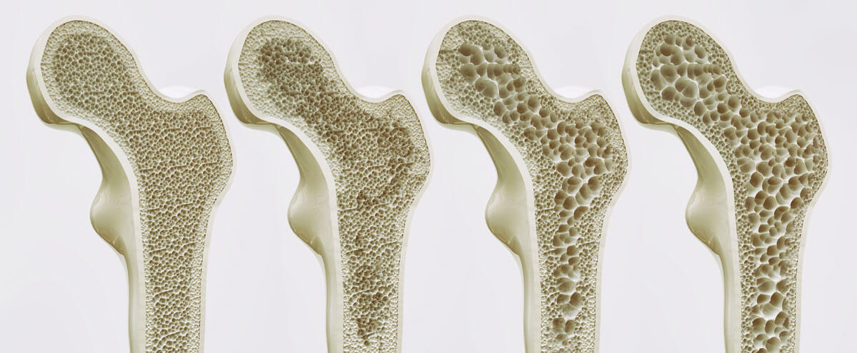 Die Stadien der Osteoporose 