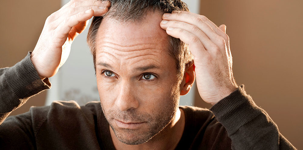 Über den Haarausfall kursieren viele Mythen 