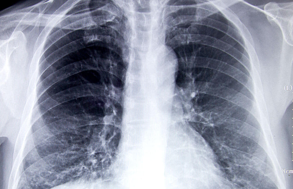 Röntgenaufnahme einer Lungenentzündung