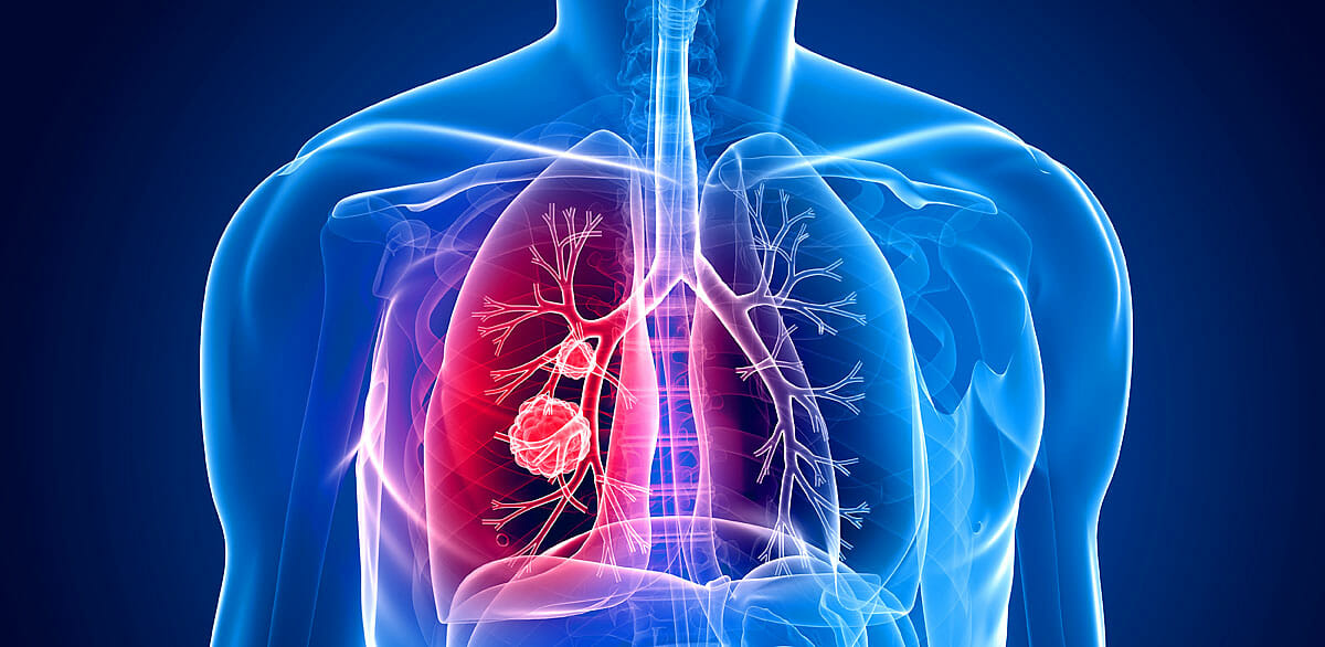 Lungenkrebs wird wegen seiner unspezifischen Symptome oft erst spät erkannt 