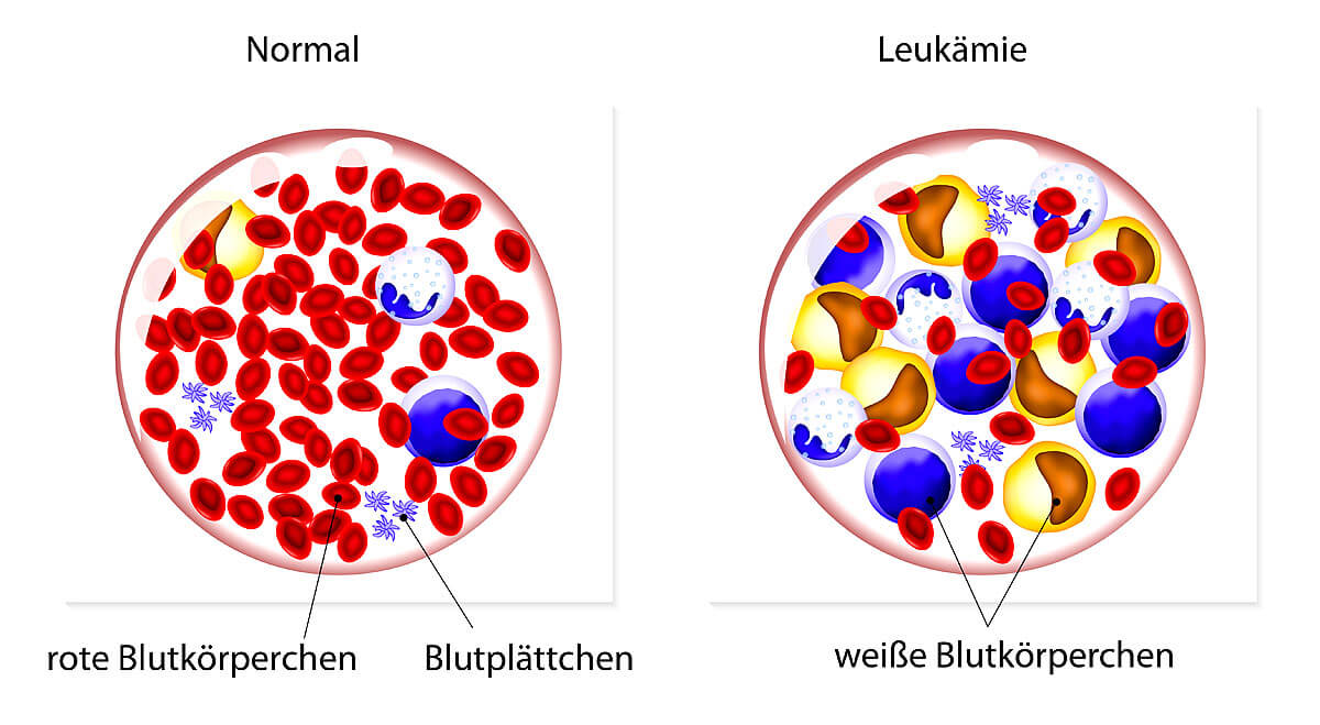 Leukämie verändert das Blutbild