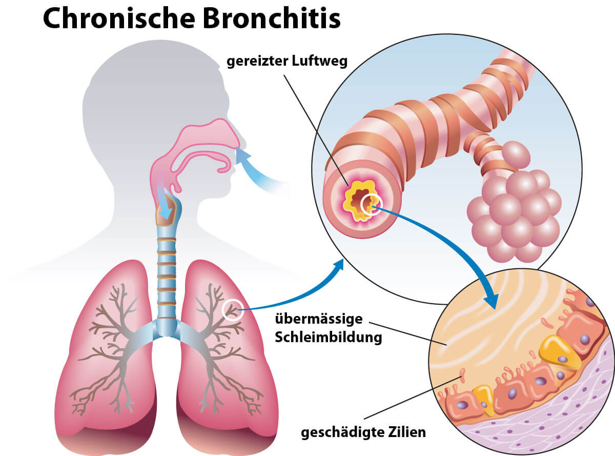 Bronchitis Symptome Die typischen Anzeichen einer Bronchitis