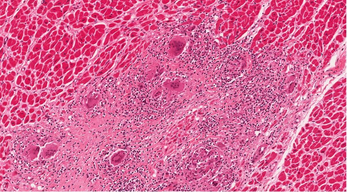 Herzmuskelentzündung: Entzündetes Herzgewebe unter dem Mikroskop