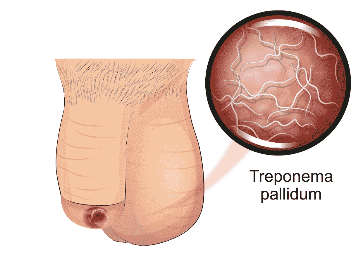 Syphilis Symptome Bilder Behandlung Prognose Was Tun - 