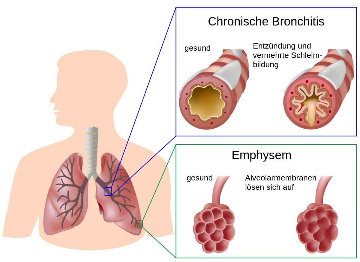 COPD - Schematische Darstellung