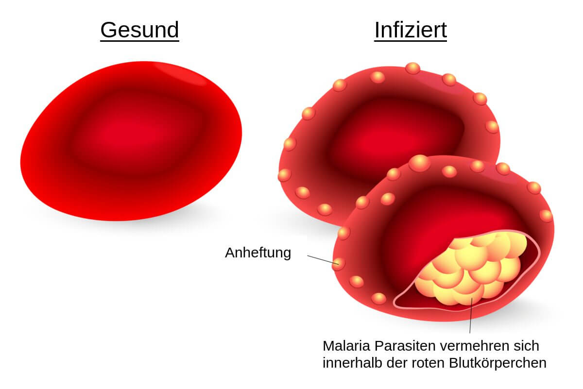 Malaria: Der Erreger vermehrt sich innerhalb der roten Blutkörperchen