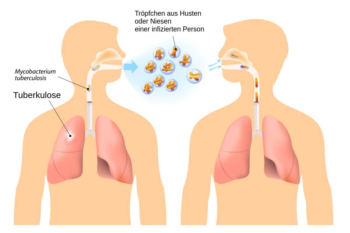 Tuberkulose Infektion