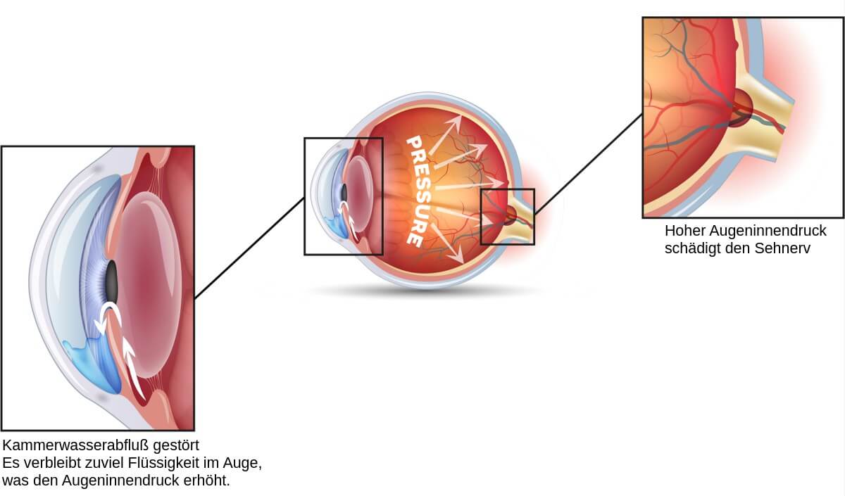 Glaukom-Ursache: Erhöhter Augeninnendruck 