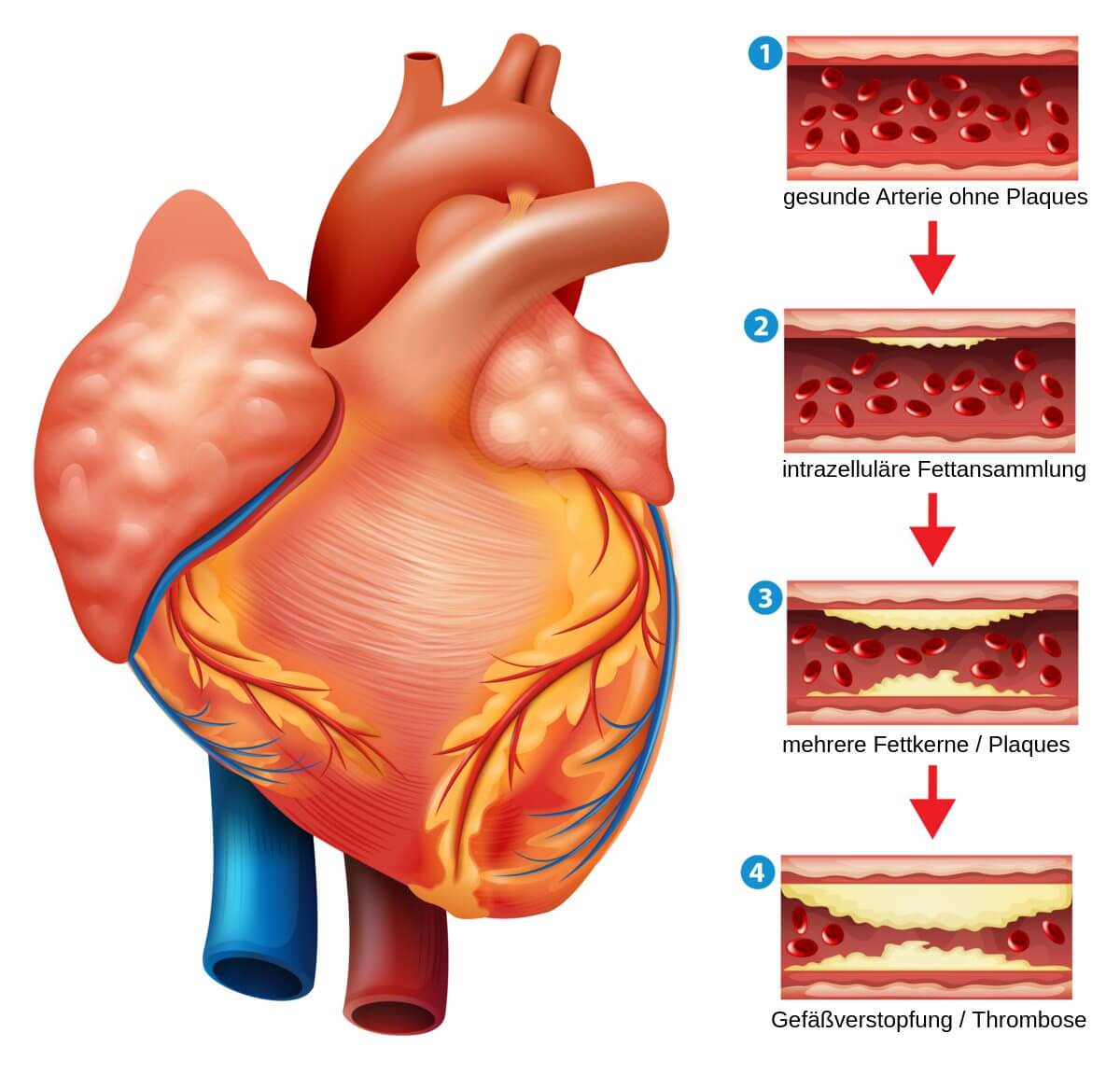 Phasen: Entstehung einer Arteriosklerose 