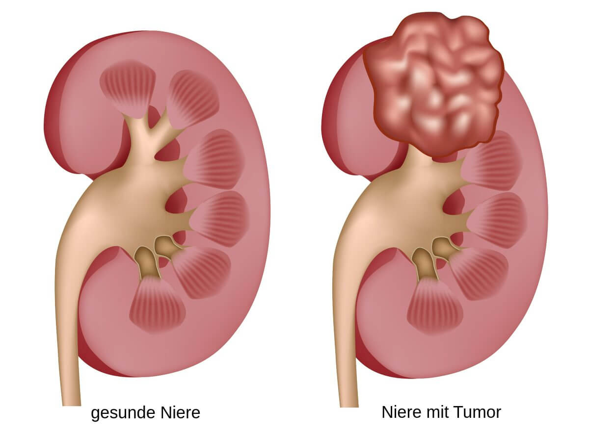 Nierenkrebs - schematische Darstellung