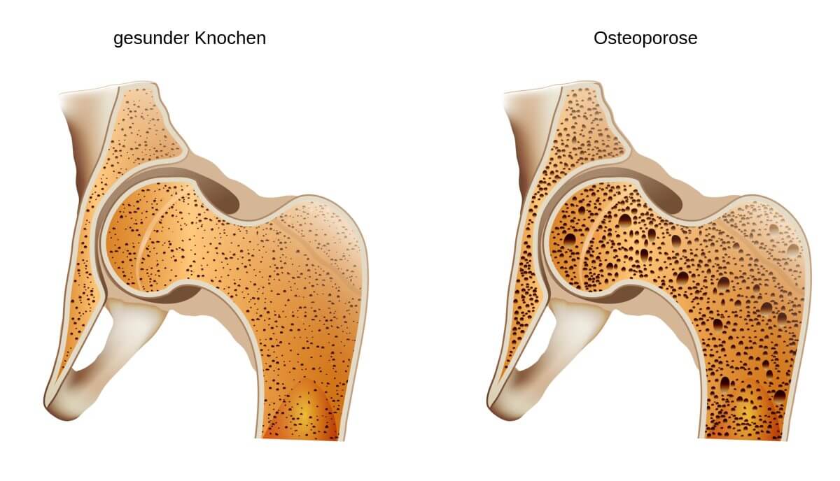 Osteoporose - schematische Darstellung 