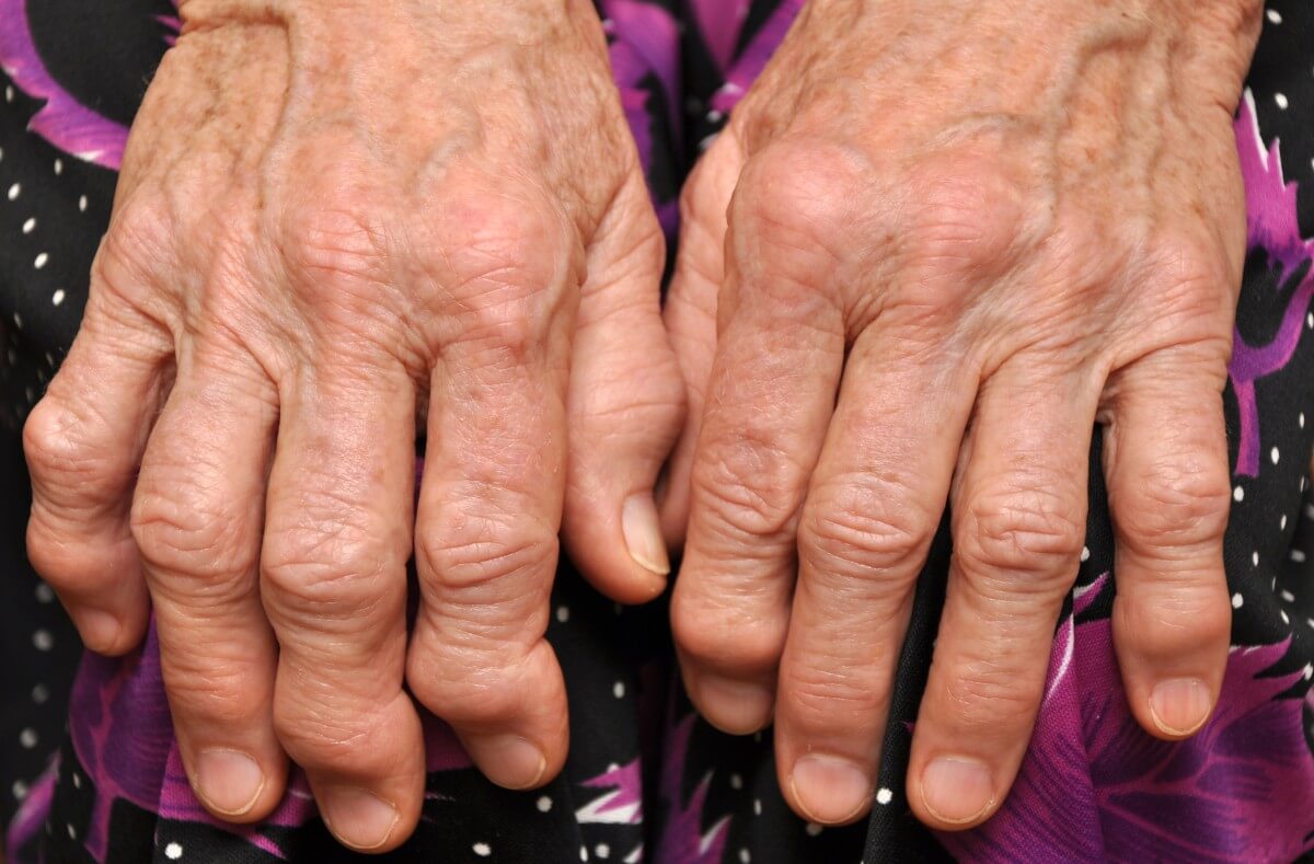 Arthritis Symptom: verformte Finger