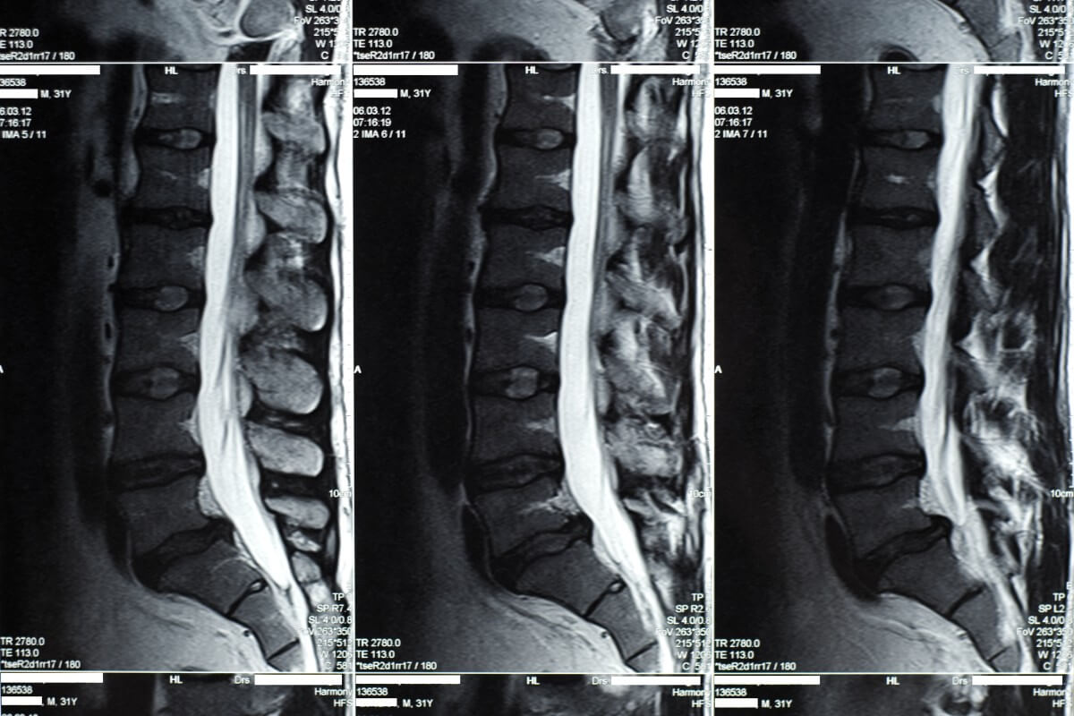 Röntgenaufnahme eines Bandscheibenvorfalls 