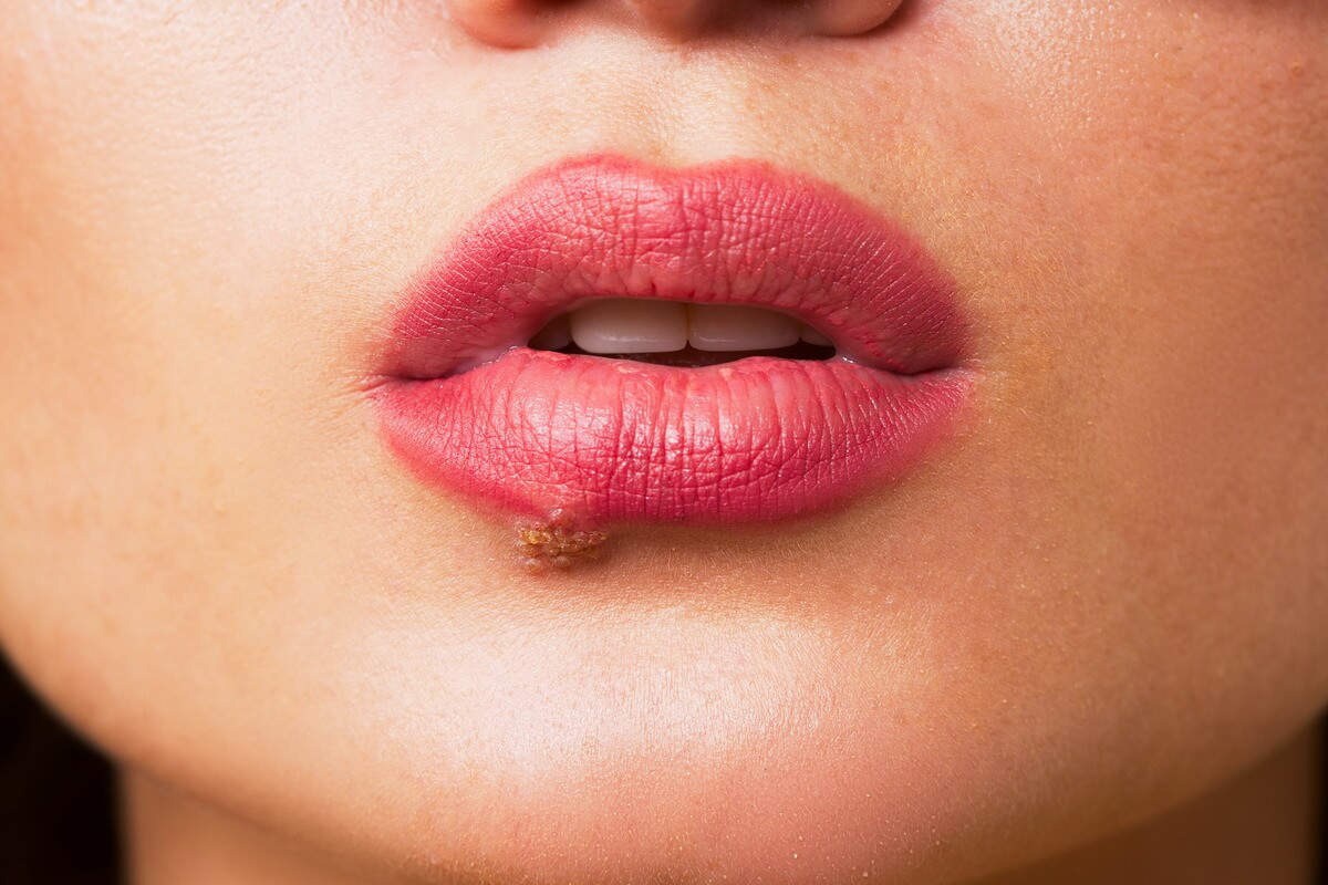 Lippenherpes Hausmittel Bilder Infektion Was Wirklich Hilft
